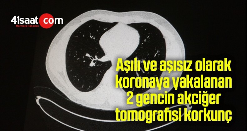 Aşılı ve aşısız olarak koronaya yakalanan 2 gencin akciğer tomografisi korkunç